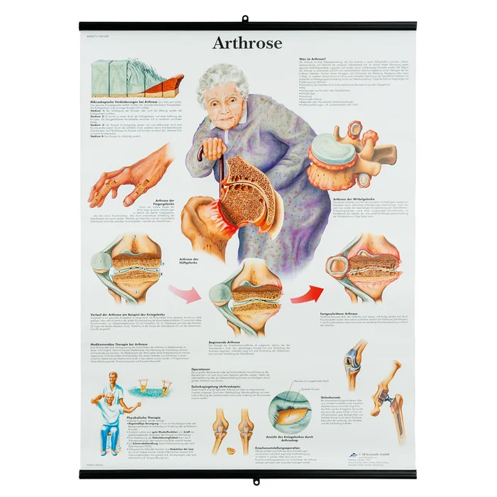 Arthrose – Poster | W-21109UB