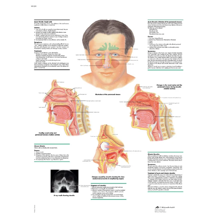 Rhinitis und Sinusitis – Poster | W-21892UB